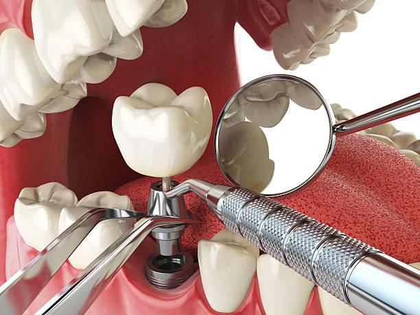 Best Emergency Wisdom Tooth Extraction in Newell, WV