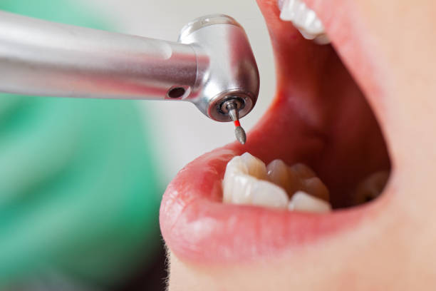 Best Lost Filling or Crown Replacement in Newell, WV